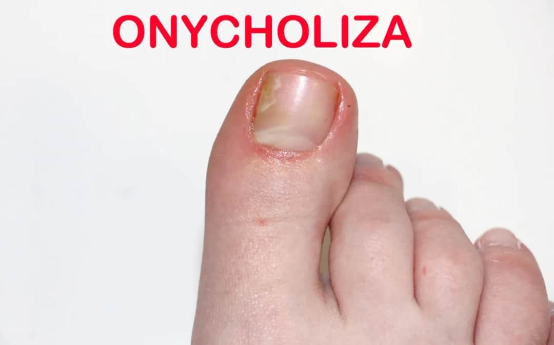 Onycholiza po hybrydzie: skuteczne metody leczenia i zapobiegania