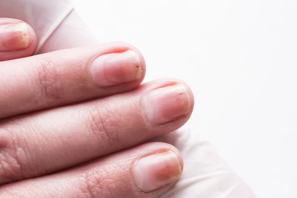 Alergia na hybrydy: objawy, jak rozpoznać i leczyć reakcję