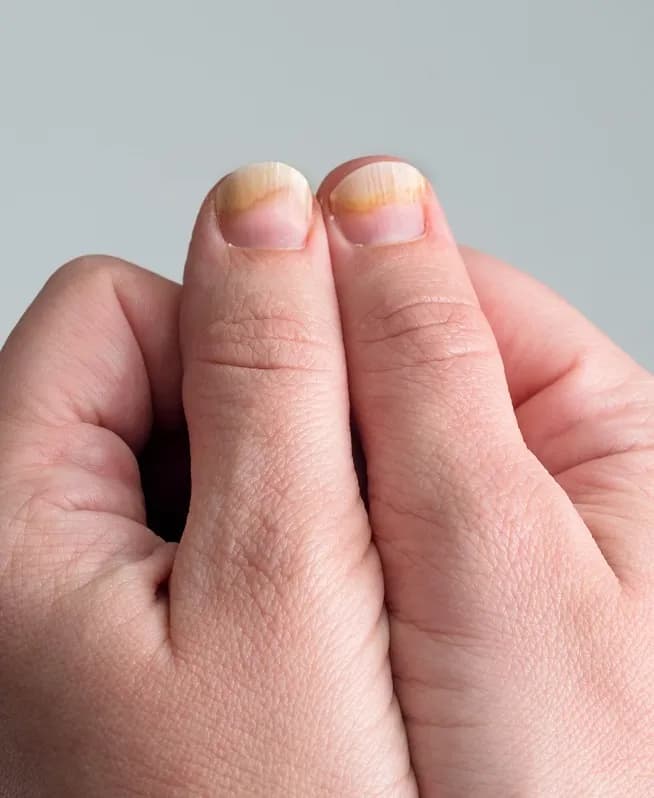 Grzybica paznokci po hybrydzie: 5 skutecznych metod leczenia